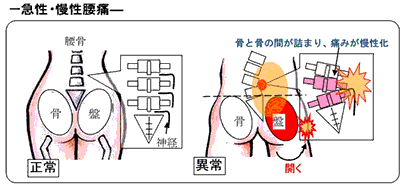 慢性腰痛の原因