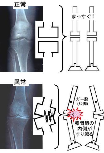 膝痛と外股の原因