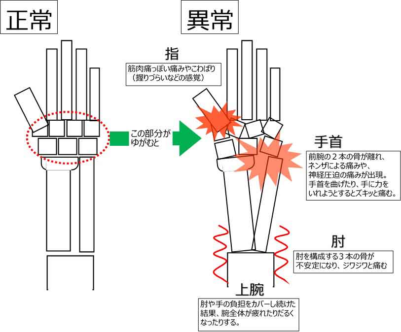 手の痛みの原因