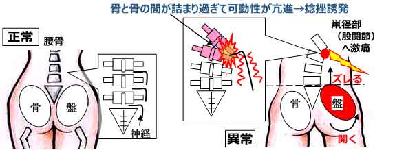 股関節痛の原因  キャプションを入力...