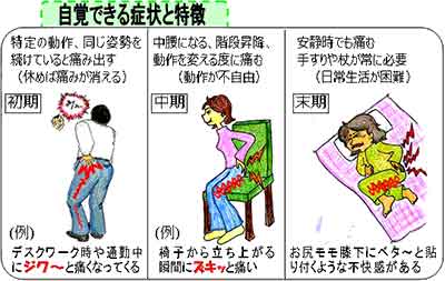 坐骨神経痛など太ももの痛みの症状や特徴