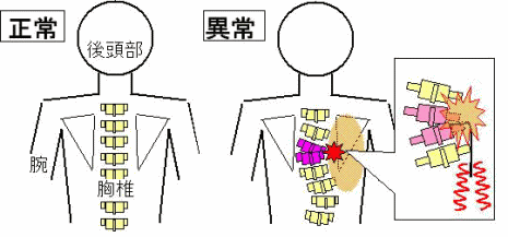 肩甲骨の内側 背中の痛みの原因 昭島の会員制骨格矯正院プレイズ 骨格矯正院プレイズ